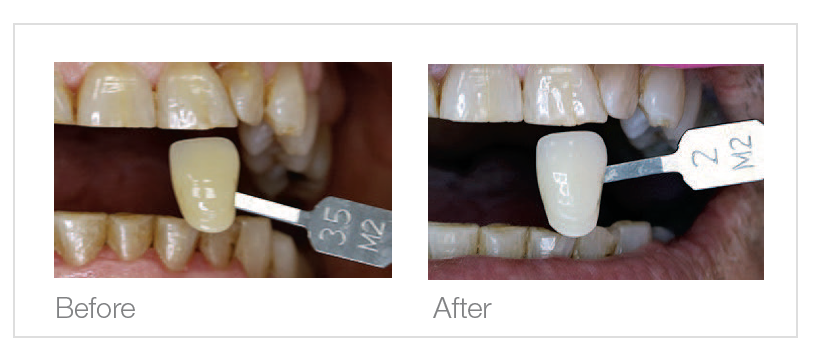 Pola White Rapid Before and After